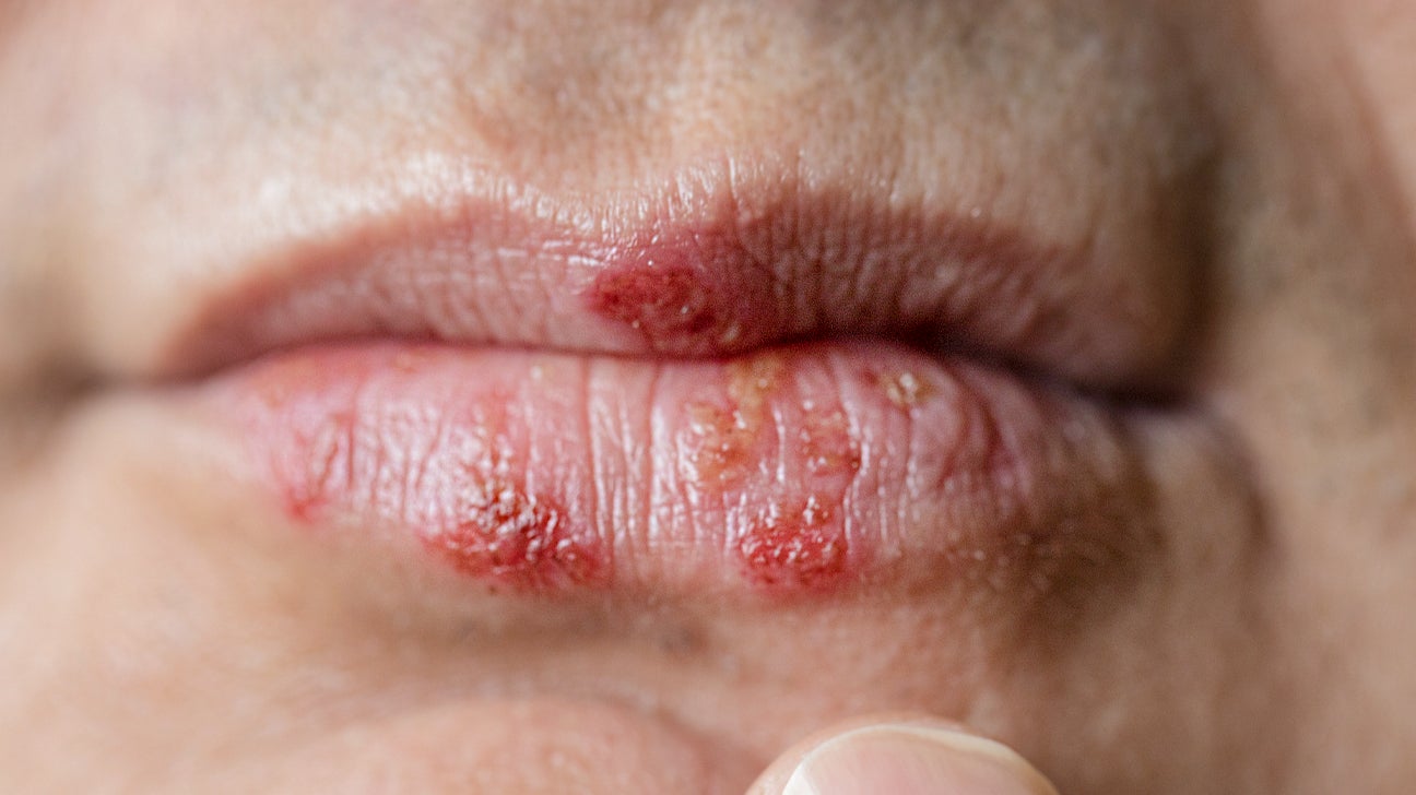 What causes blisters on sale on lips