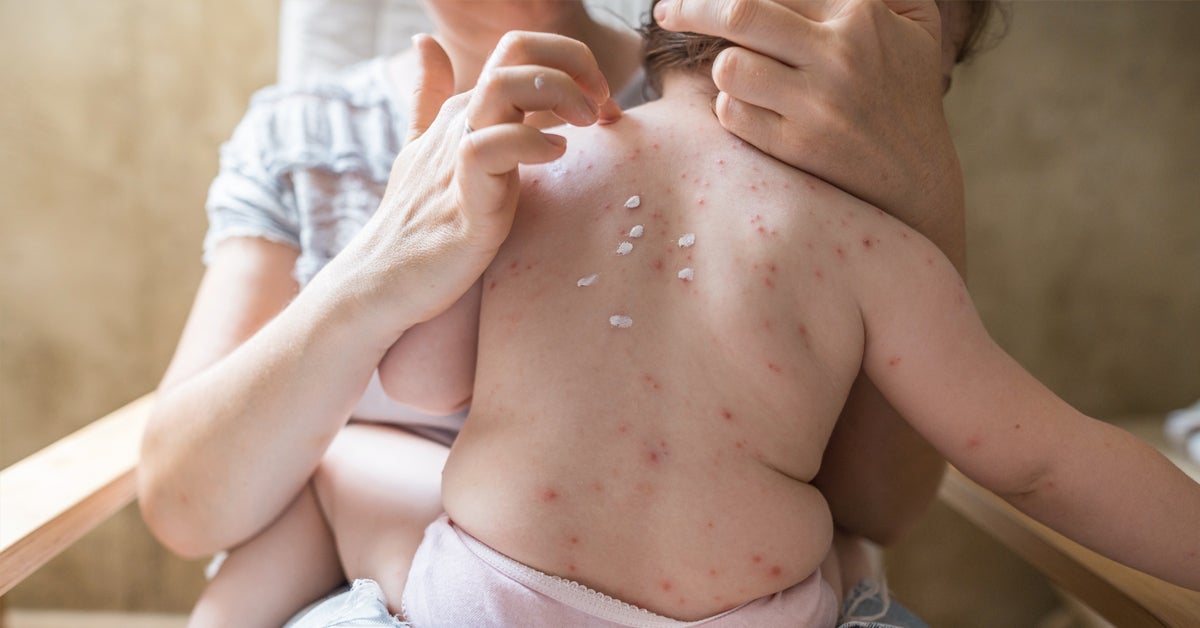 chicken pox pictures in adults