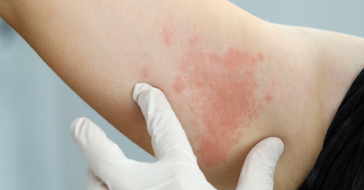 Why Do Hives Occur with HIV?