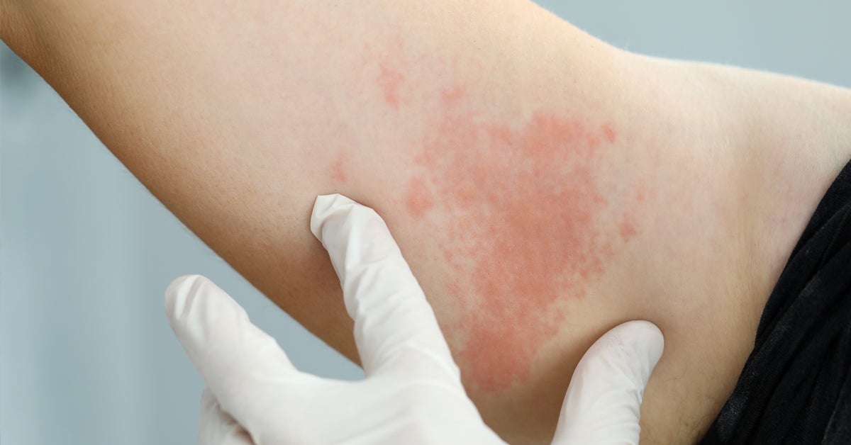 can lisinopril cause hives and itching