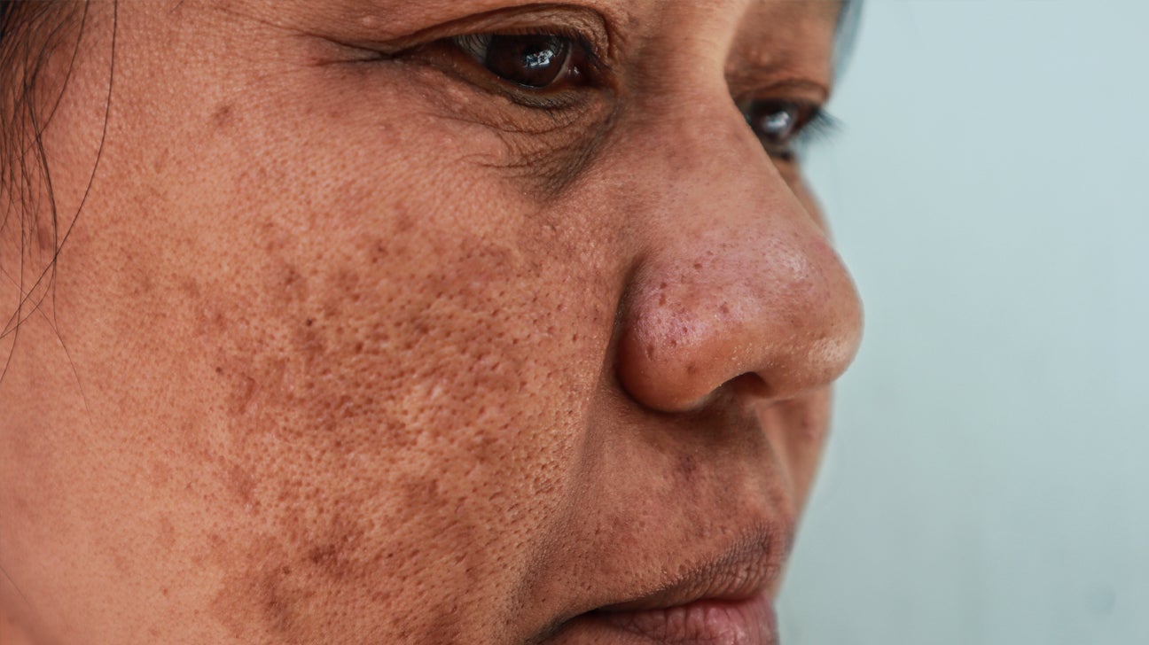 What are dark spots on skin and How Can You Treat Them?