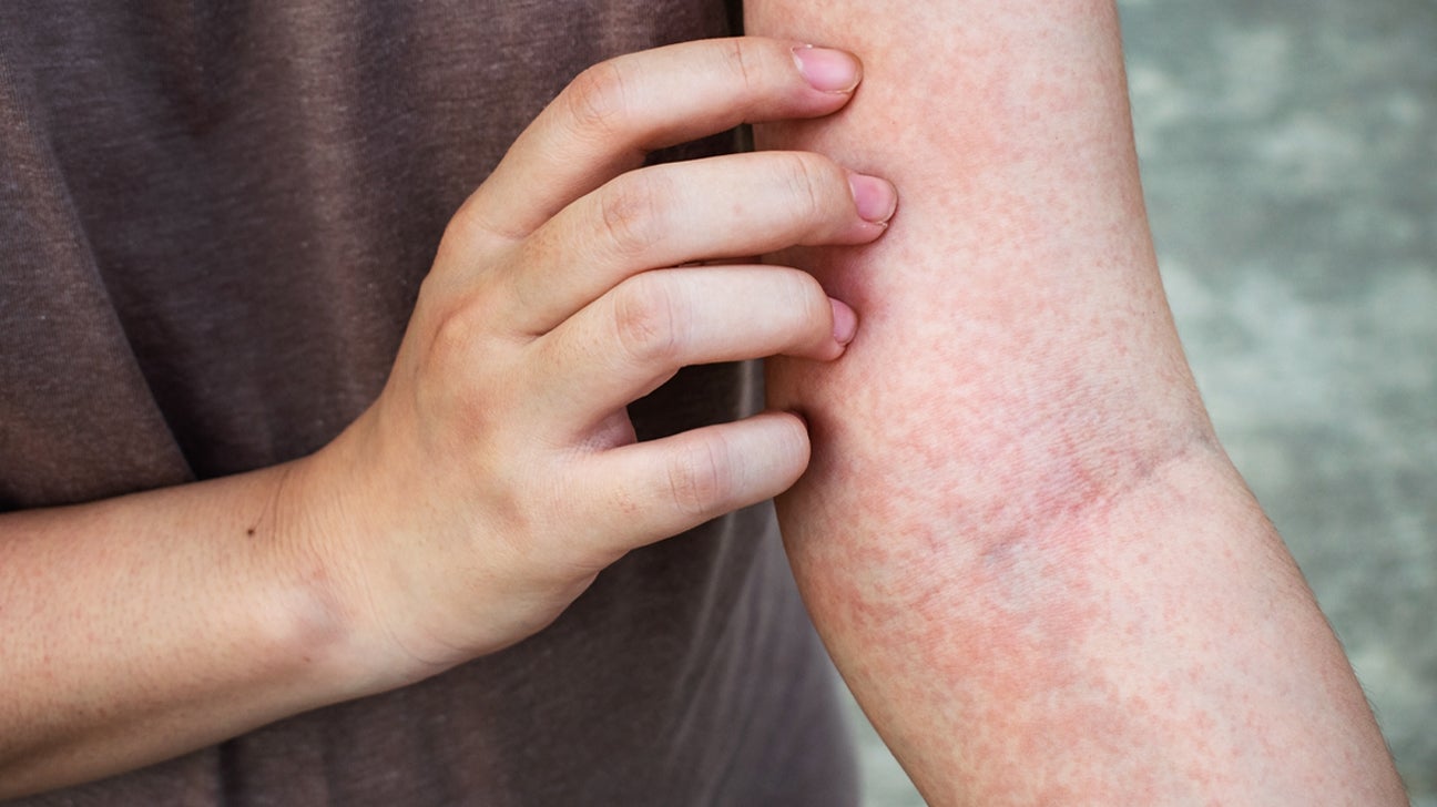 Skin rash: Causes, 71 pictures of symptoms, and treatments