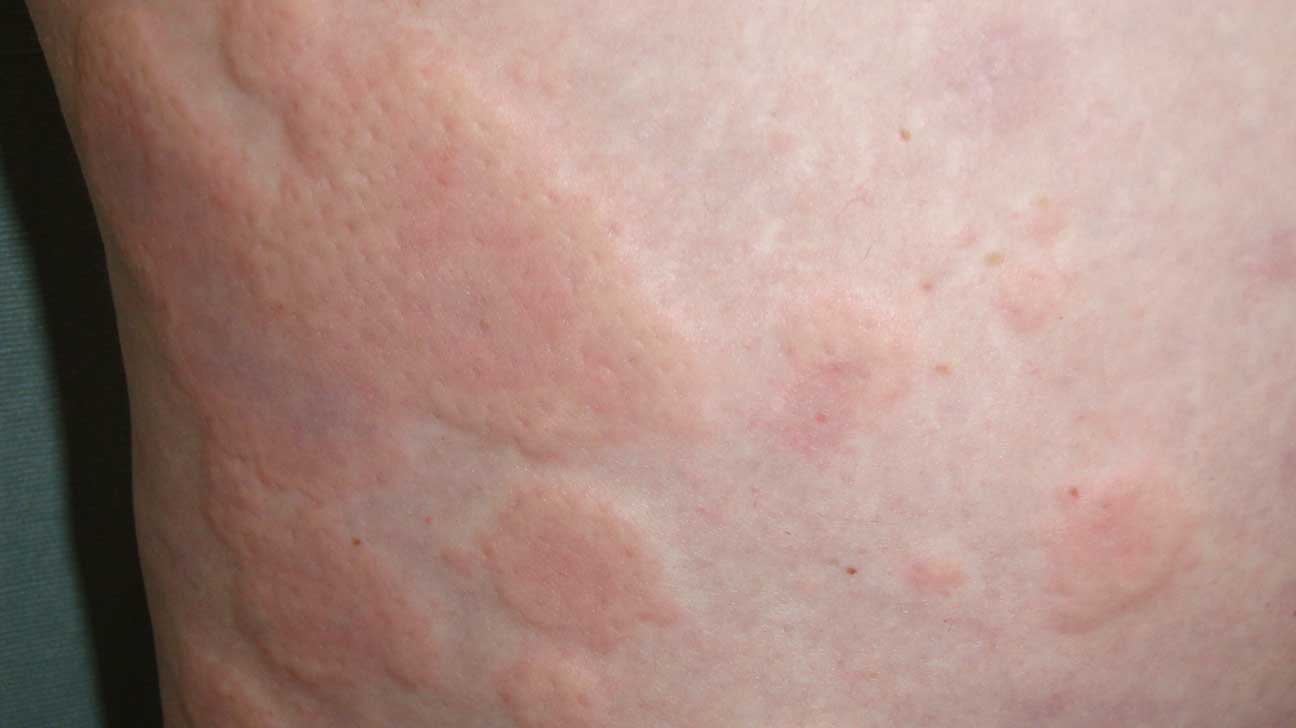 severe urticaria treatment