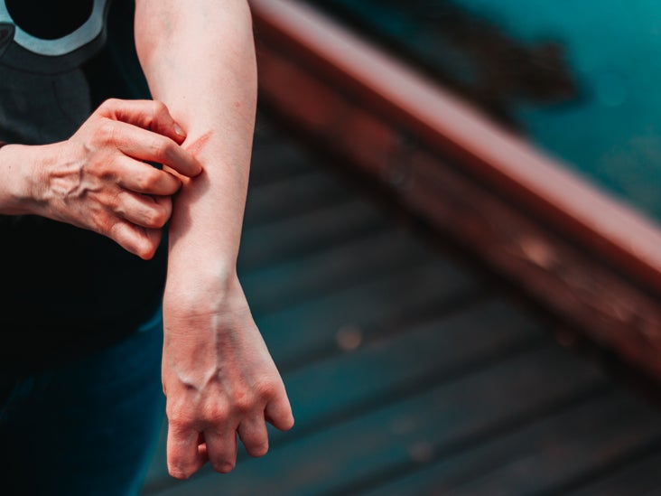 Causes of Nausea in People with Eczema