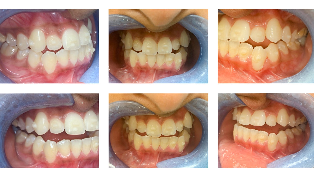Invisalign Attachments Benefits, Procedure, Care, and More