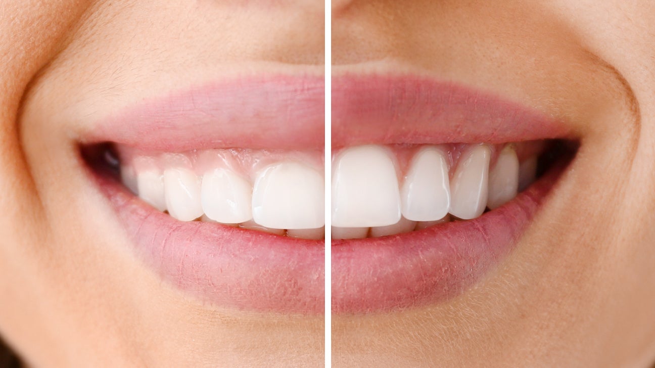 Gum Lift / Gum Contoring cityName Transform Your Smile with a Gum Lift