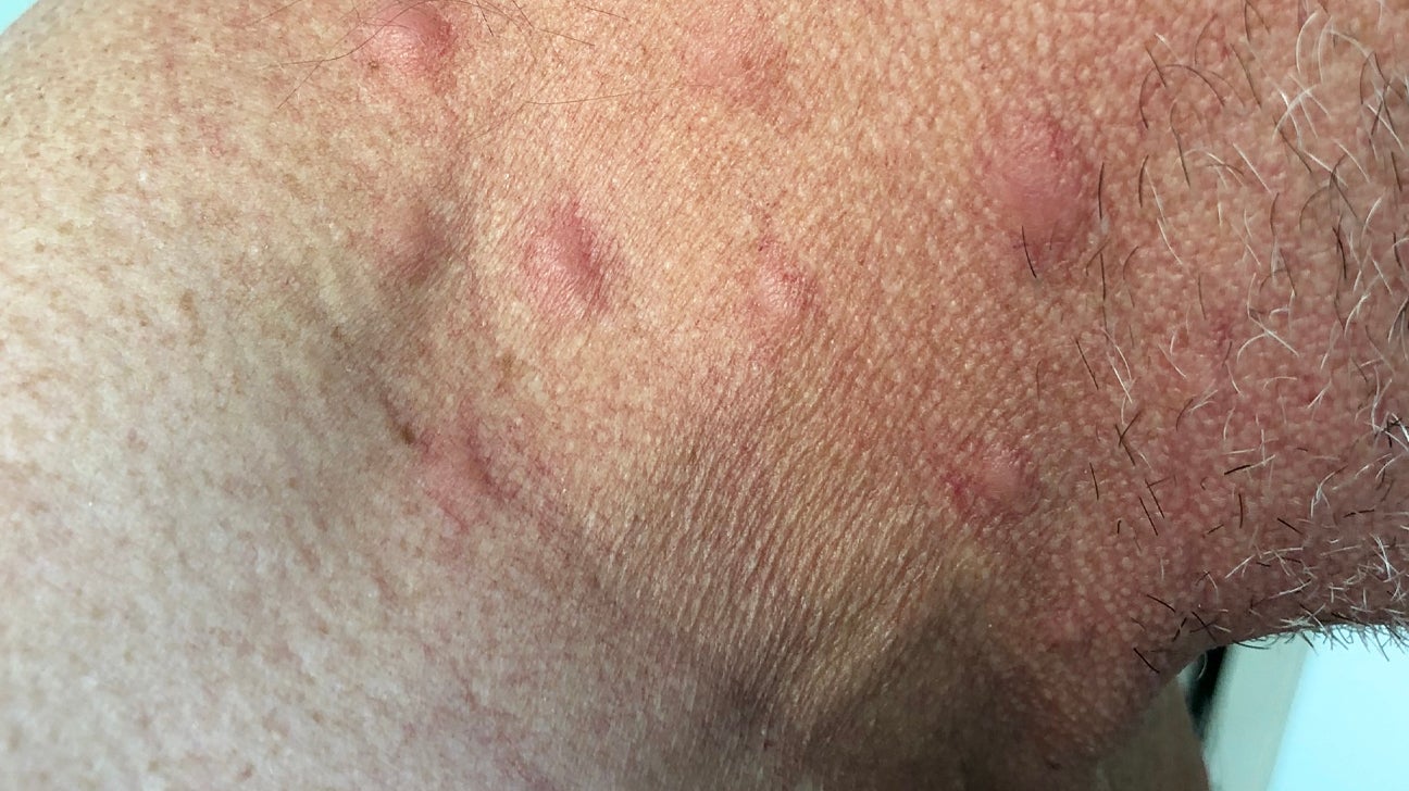 Why Do Hives Occur With Hiv