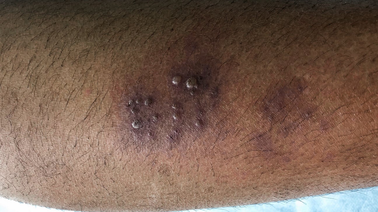 Allergy Trigger Shingles Rash On Dark Skin