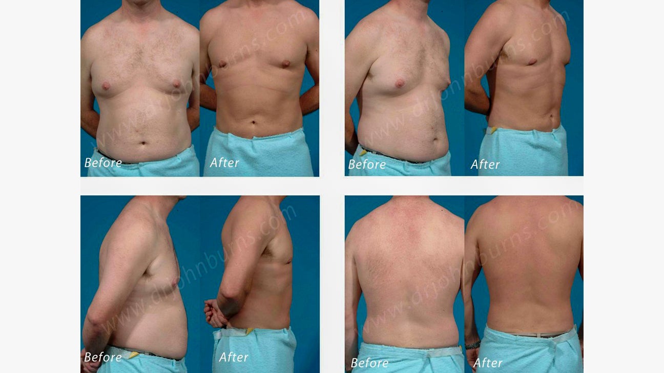 Liposuction vs Non-Invasive Fat Reduction Treatments - Blog