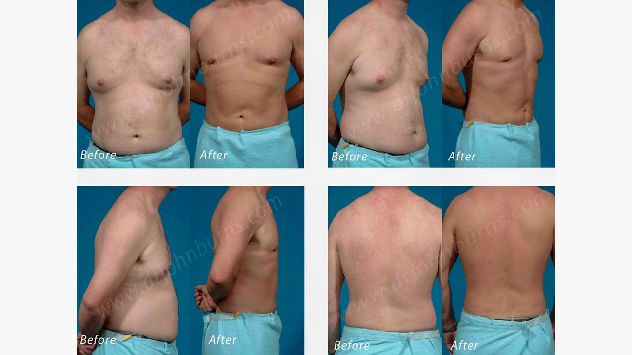 Cost Of Liposuction Austin