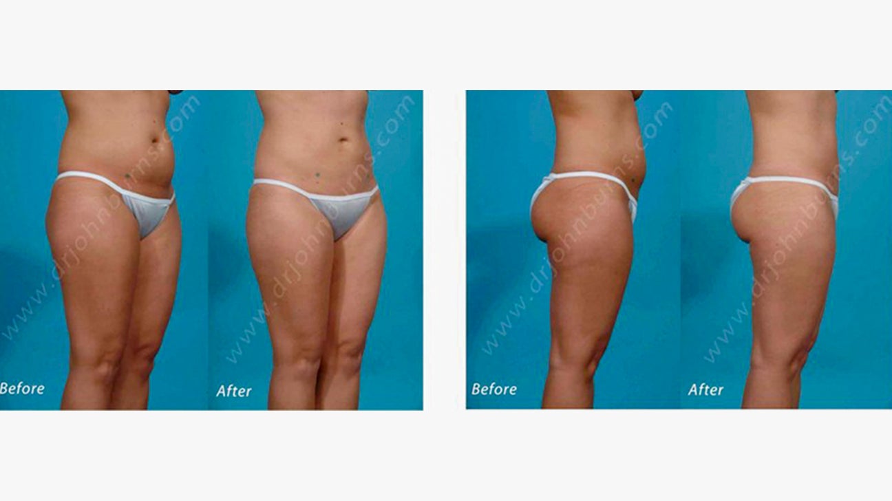 Tumescent Liposuction Benefits, Precautions, Pictures, and Costs