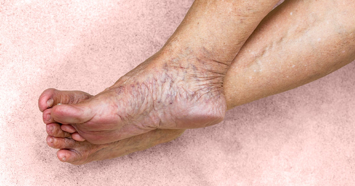 early stages of venous insufficiency)