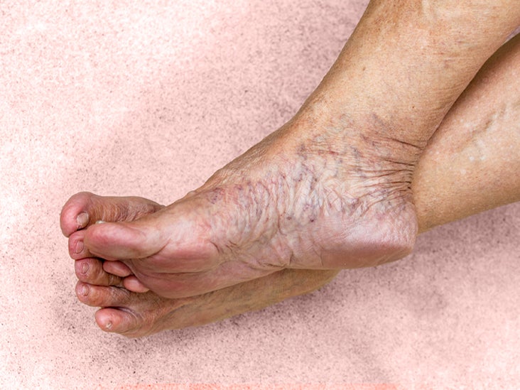 Limfostaza picioarelor - Ulcere 