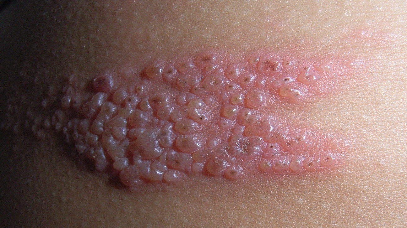 Rash★ Shingles vs. poison ivy: How to tell the difference