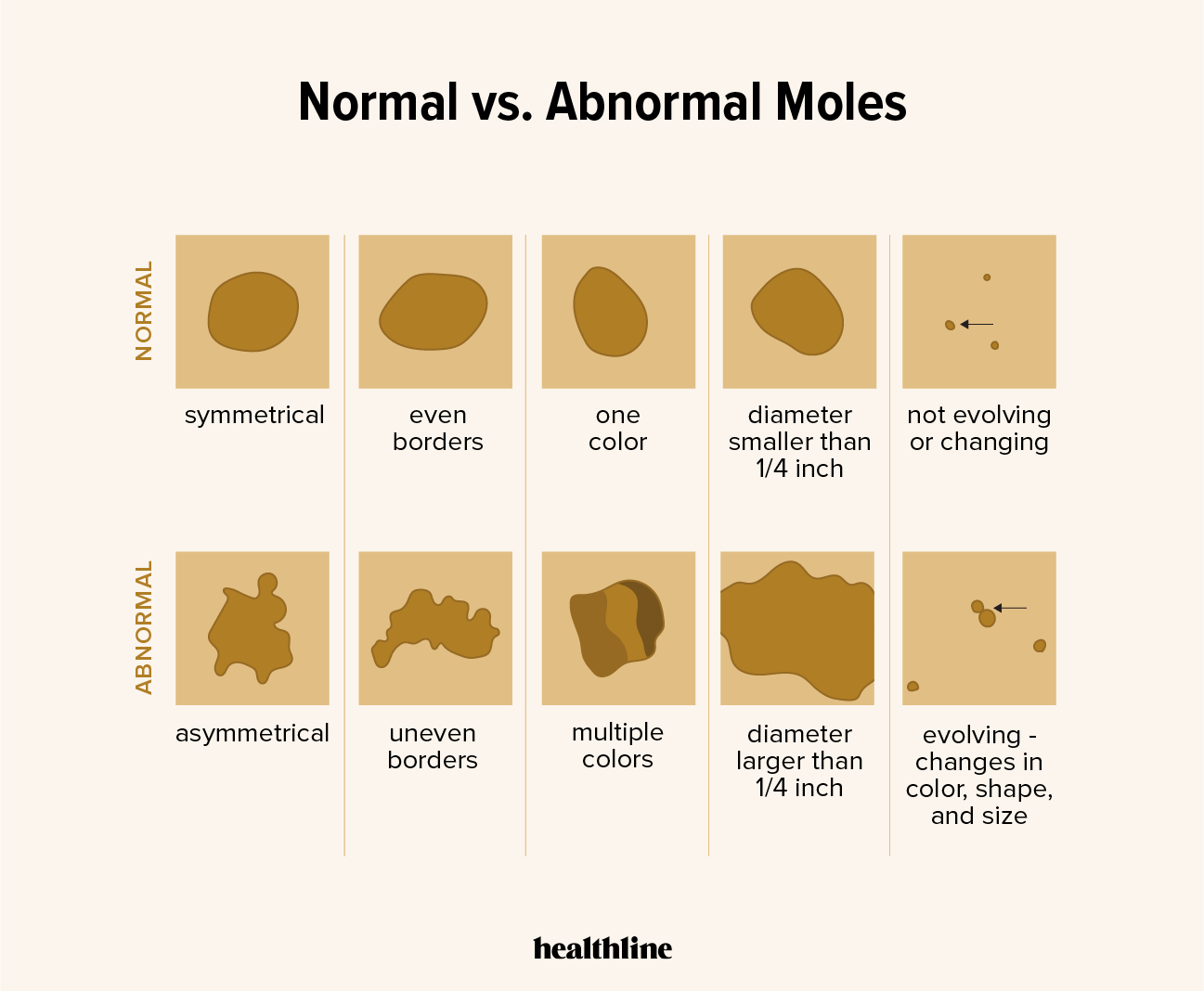 Download Malignant Melanoma Vs Normal Mole Pictures