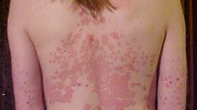 erythrodermic psoriasis