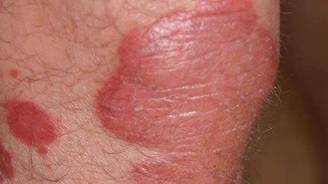 erythrodermic psoriasis treatment uptodate)