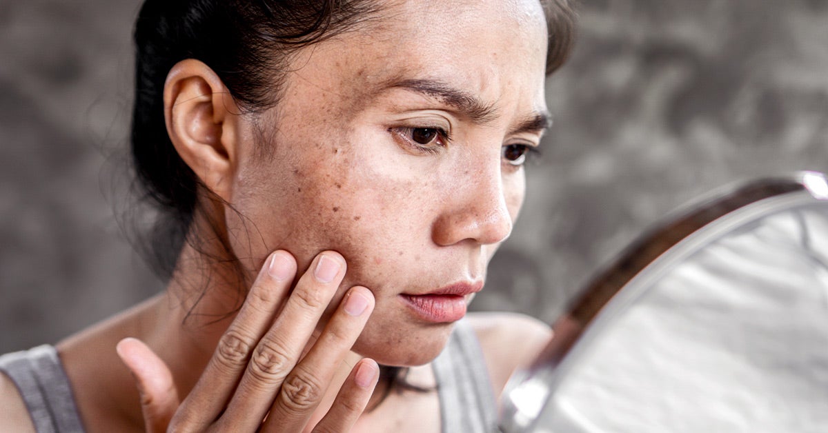 Pitted Acne Scars: How They Happen and How to Get Rid of Them