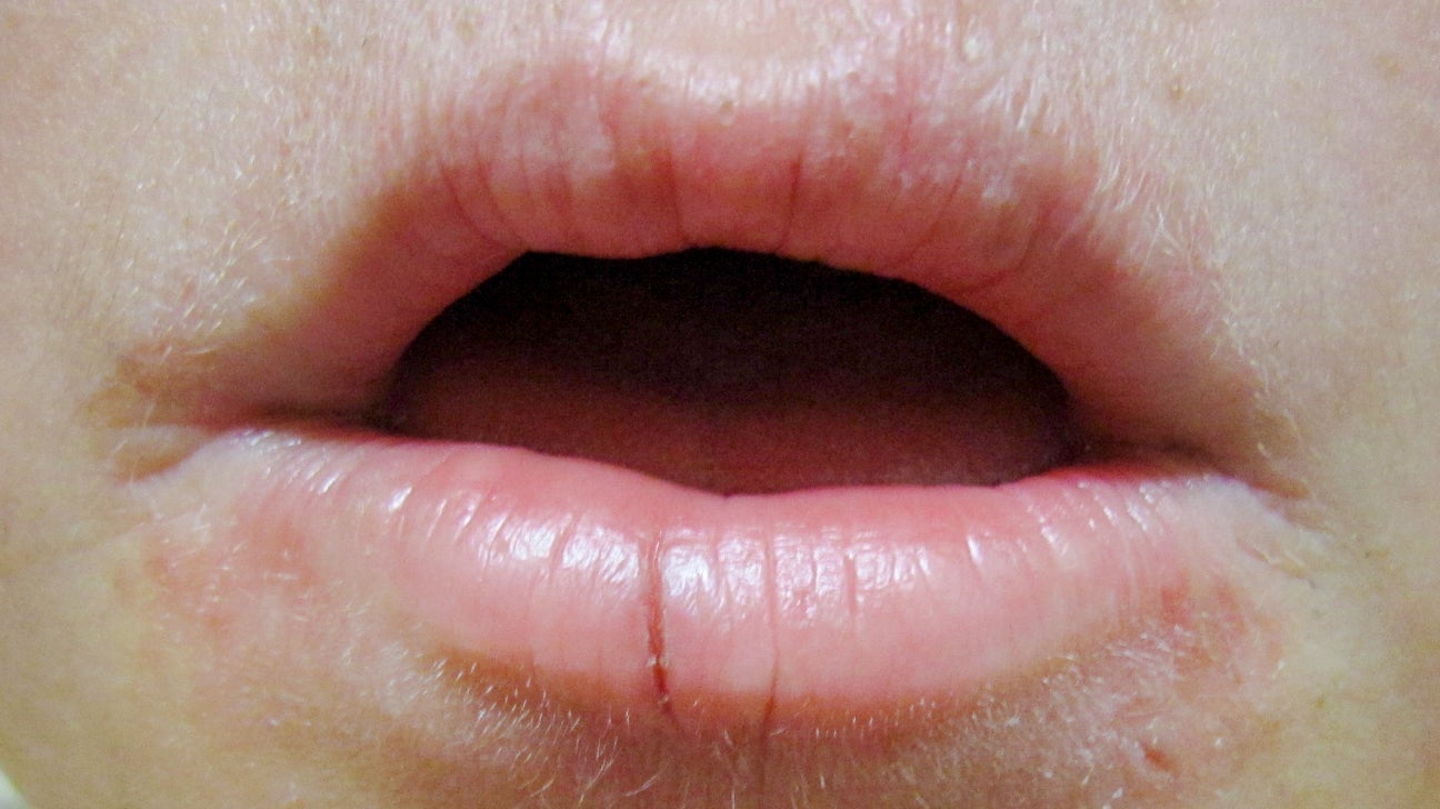 Eczema How To Get Rid Of Red Ring Around Lips