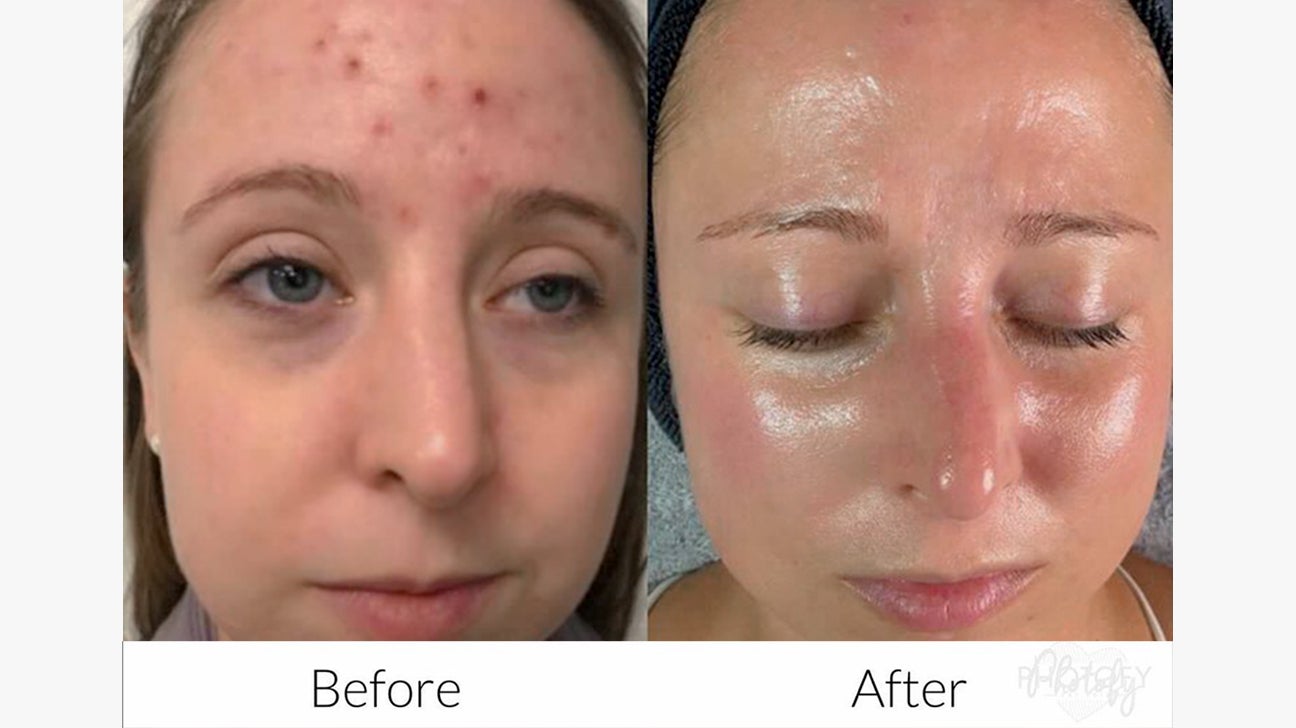 microneedling ogden