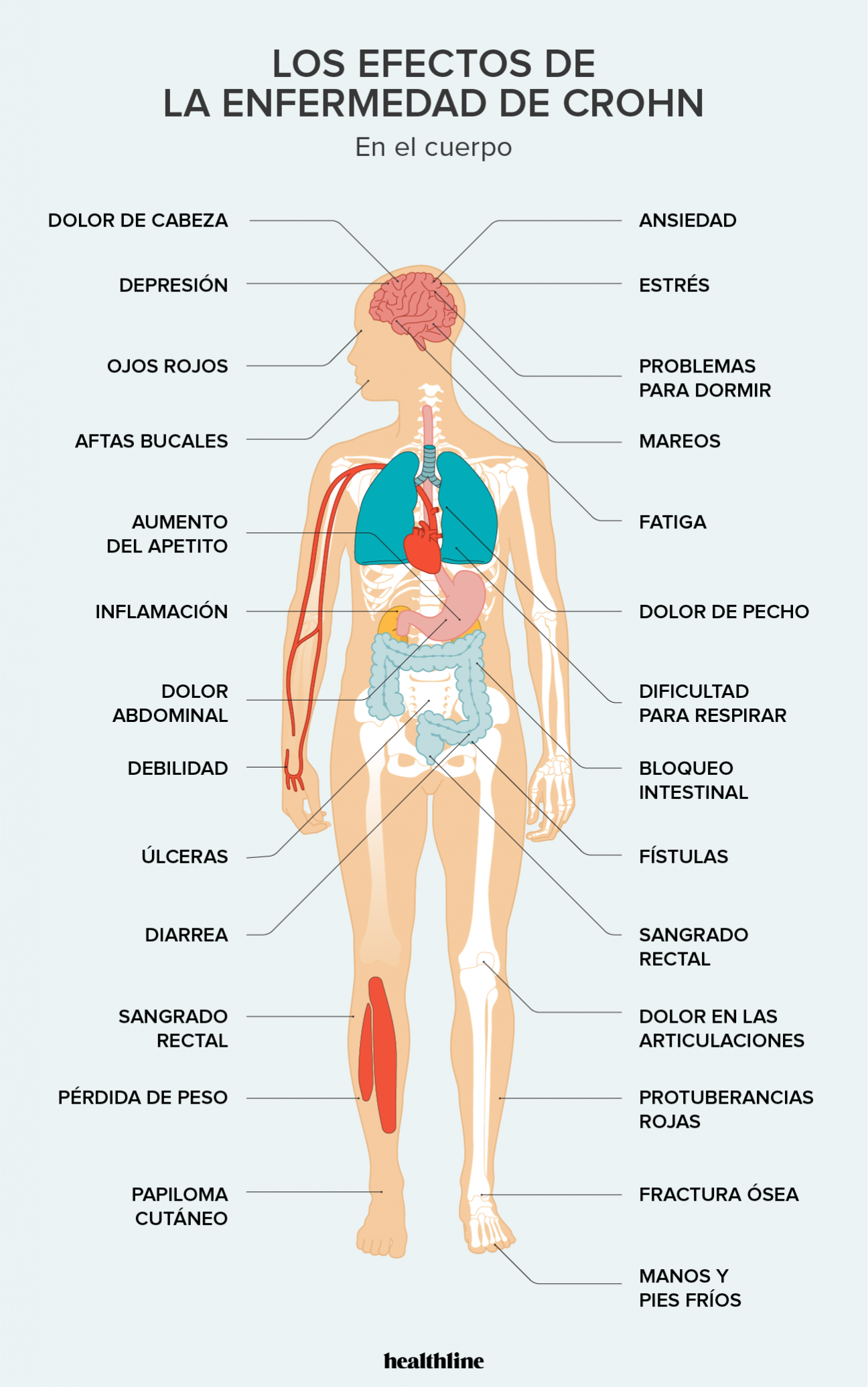 Enfermedad de Crohn