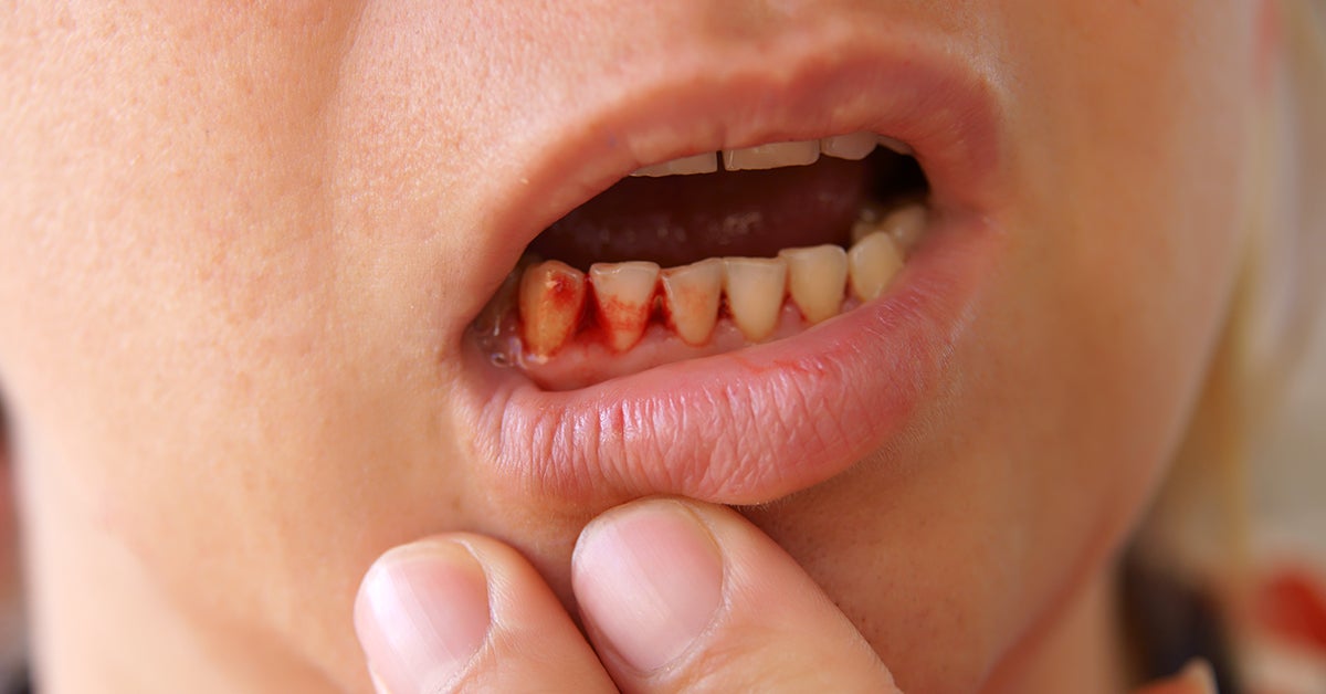 Cut On The Gums Appearance Home Remedies And Treatments