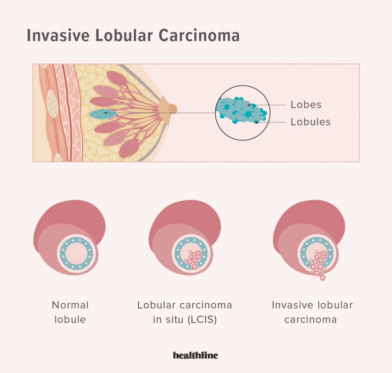 Invasive Ductal Carcinoma