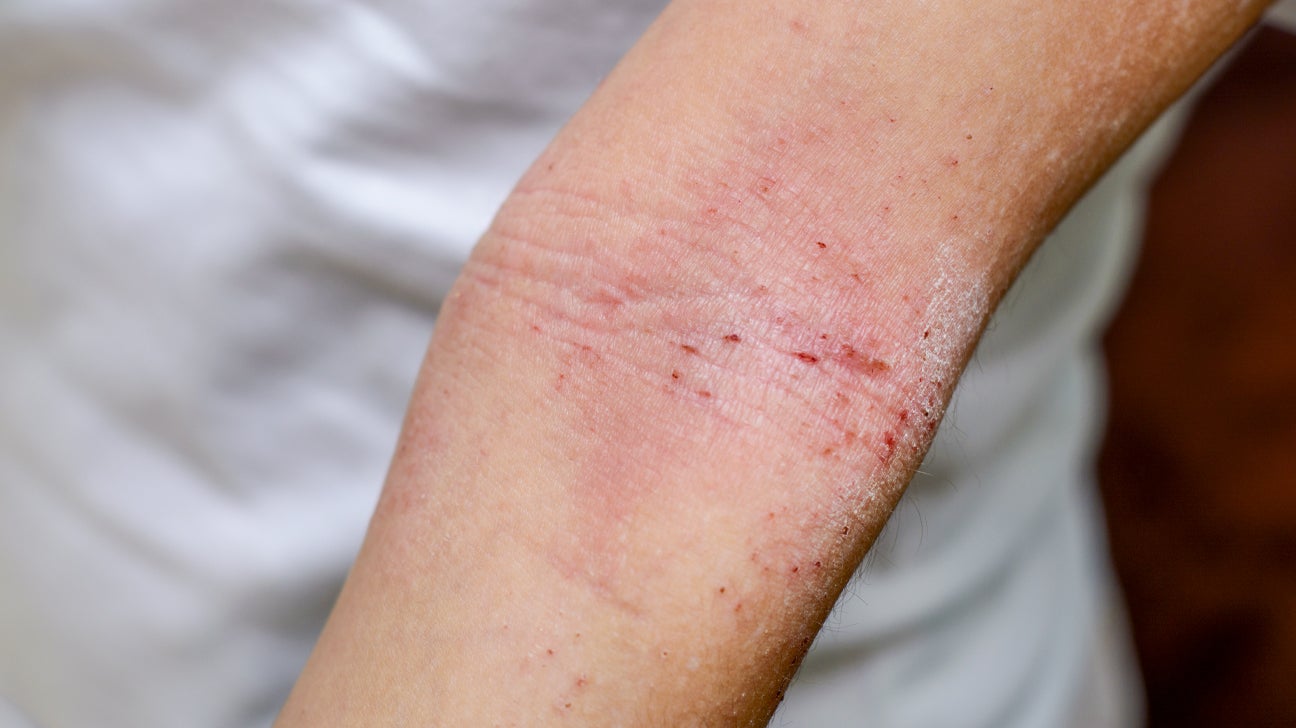 Eczema Vs Hives Similarities Differences Treatment And More