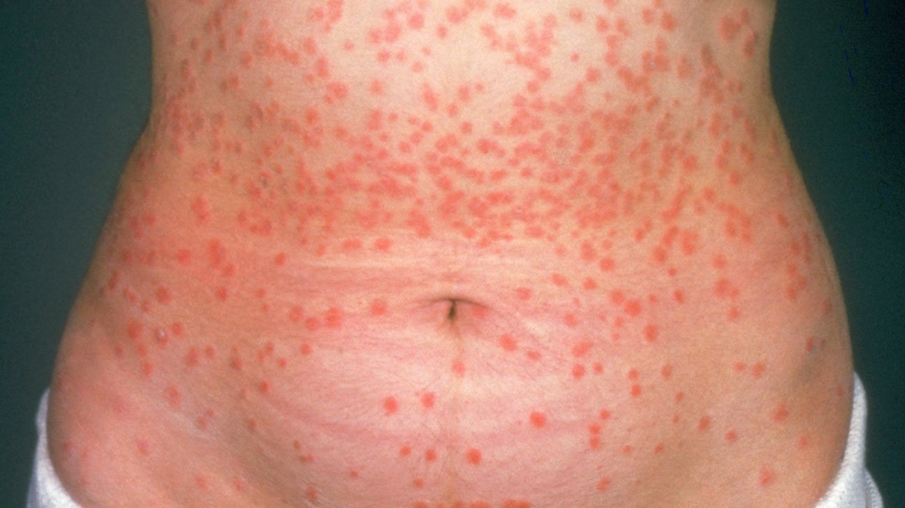 what triggers psoriasis rash vörös foltok jelentek meg a bőrön viszketnek és fájnak