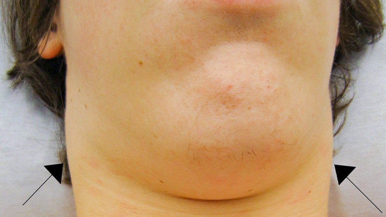 enlarged lymph node in back of neck