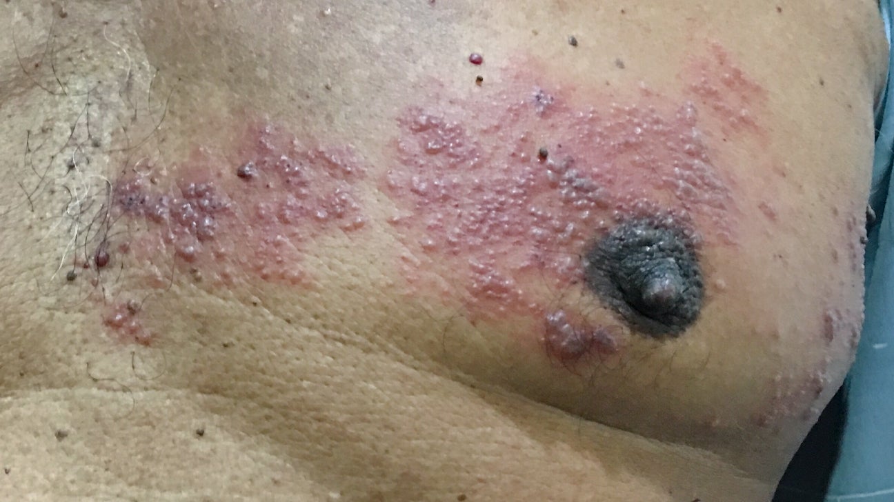 Mild Shingles On Chest