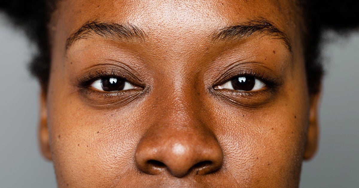 Hyperpigmentation on Black Skin - Healthline