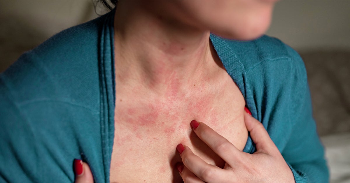 how do i stop eczema itching at night