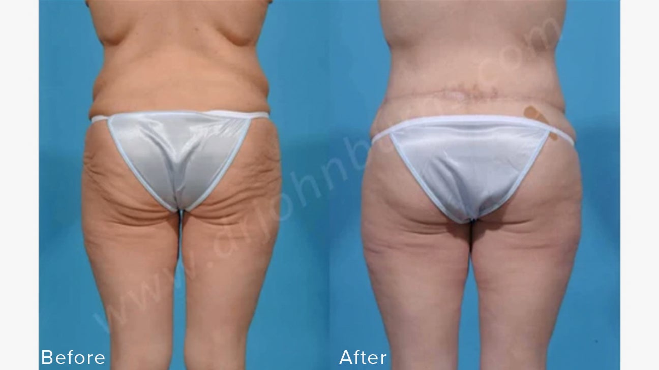 All About The Body Lift Procedure: Costs, Candidacy & More