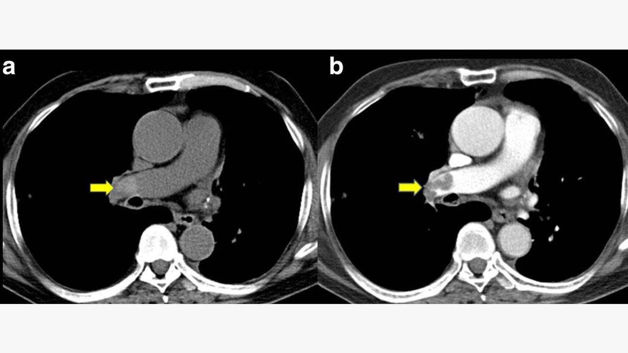 Pulmonary Embolism Causes Symptoms And Treatment 60 OFF