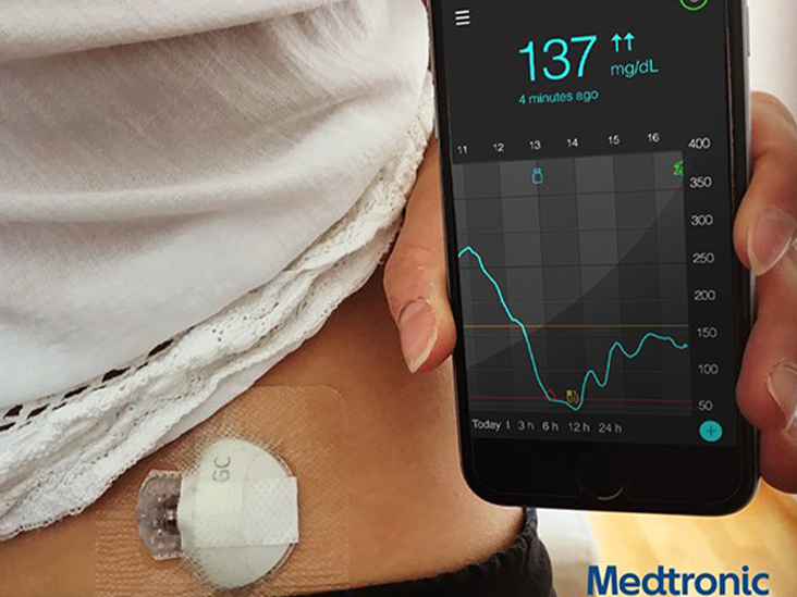 Medtronic Guardian Connect – Nightscout Kézikönyv