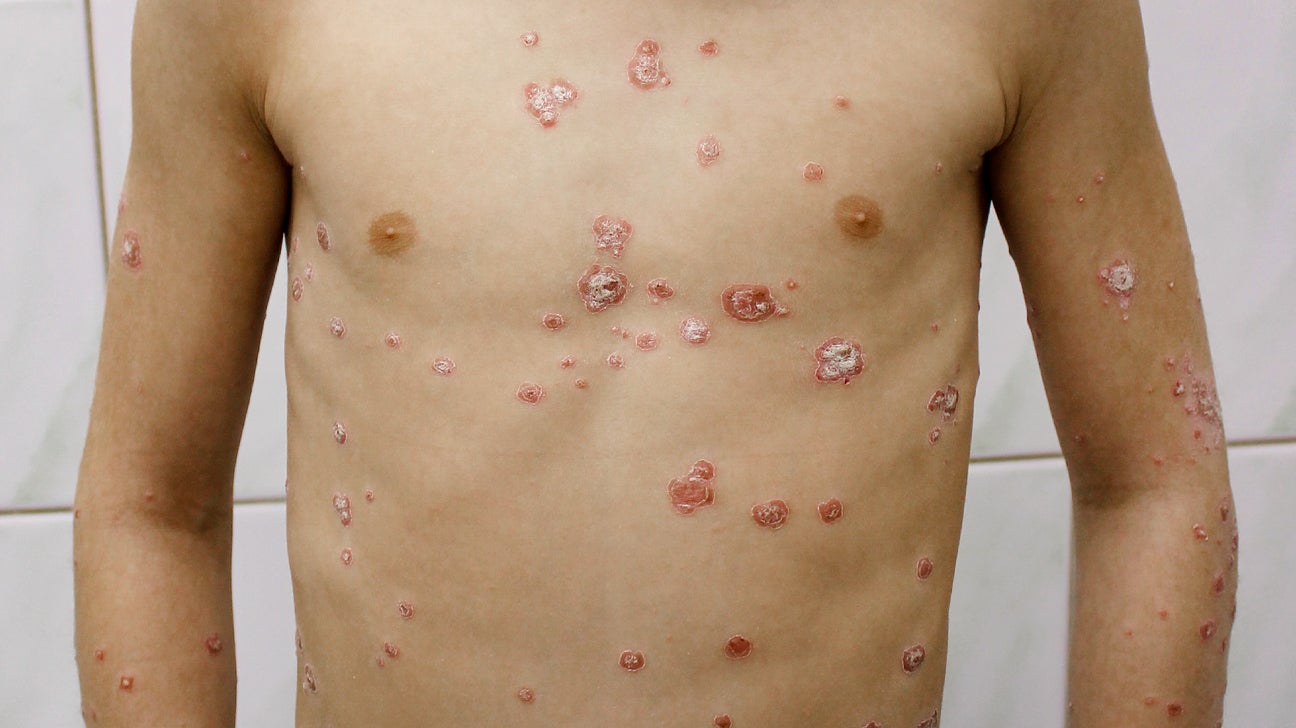 Psoriasis in Children: Pediatric Psoriasis Symptoms, Types, More