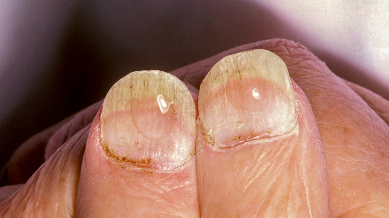 nail és arthritis gomba)