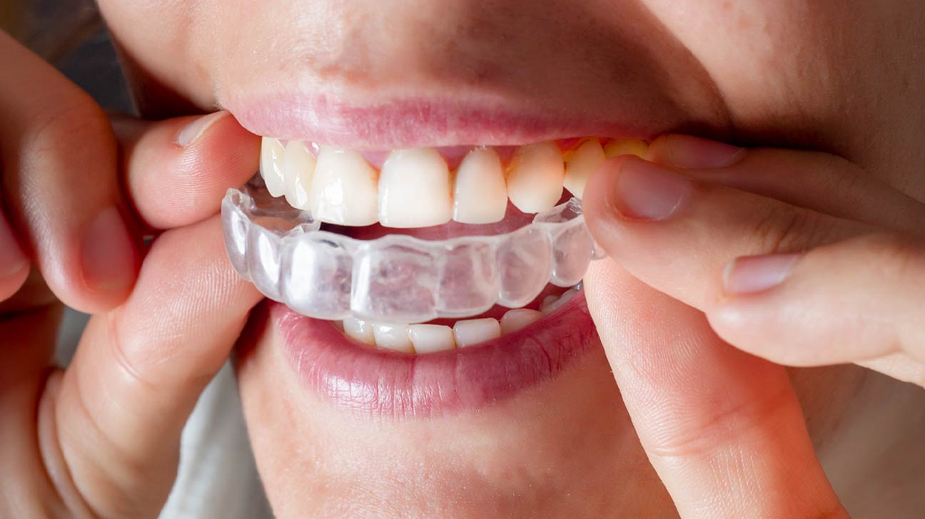 How Can I Keep My Invisalign Attachments and Invisalign Trays Clean?