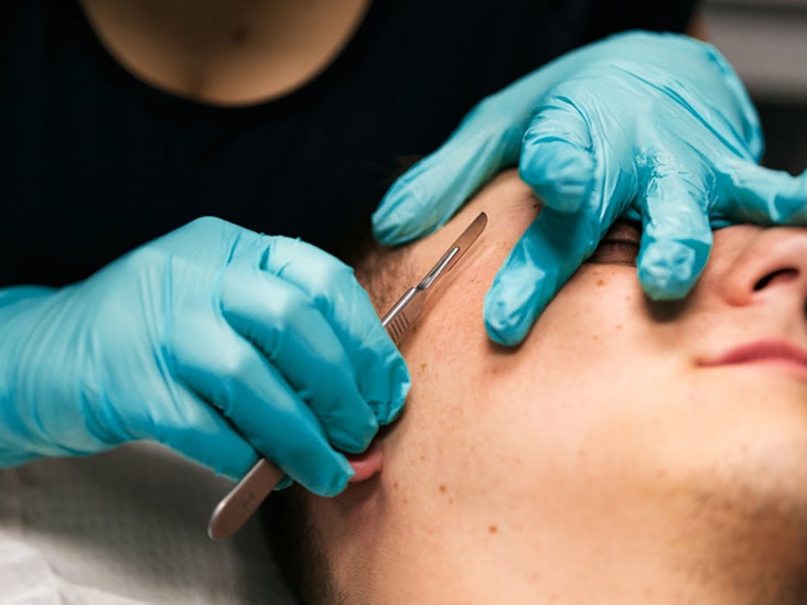 What S The Difference Between Microdermabrasion And Dermaplaning
