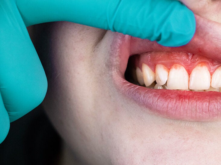 What Causes Swollen Gums And Lips