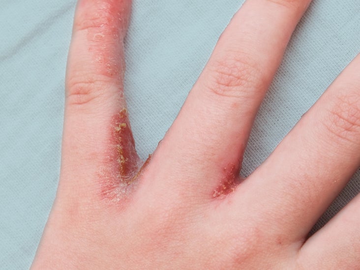 mild psoriasis on hands