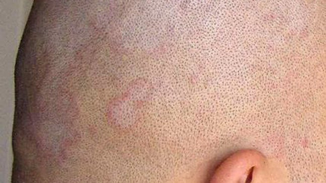 Seborrheic Dermatitis On Scalp Treatment Crib Cap And More