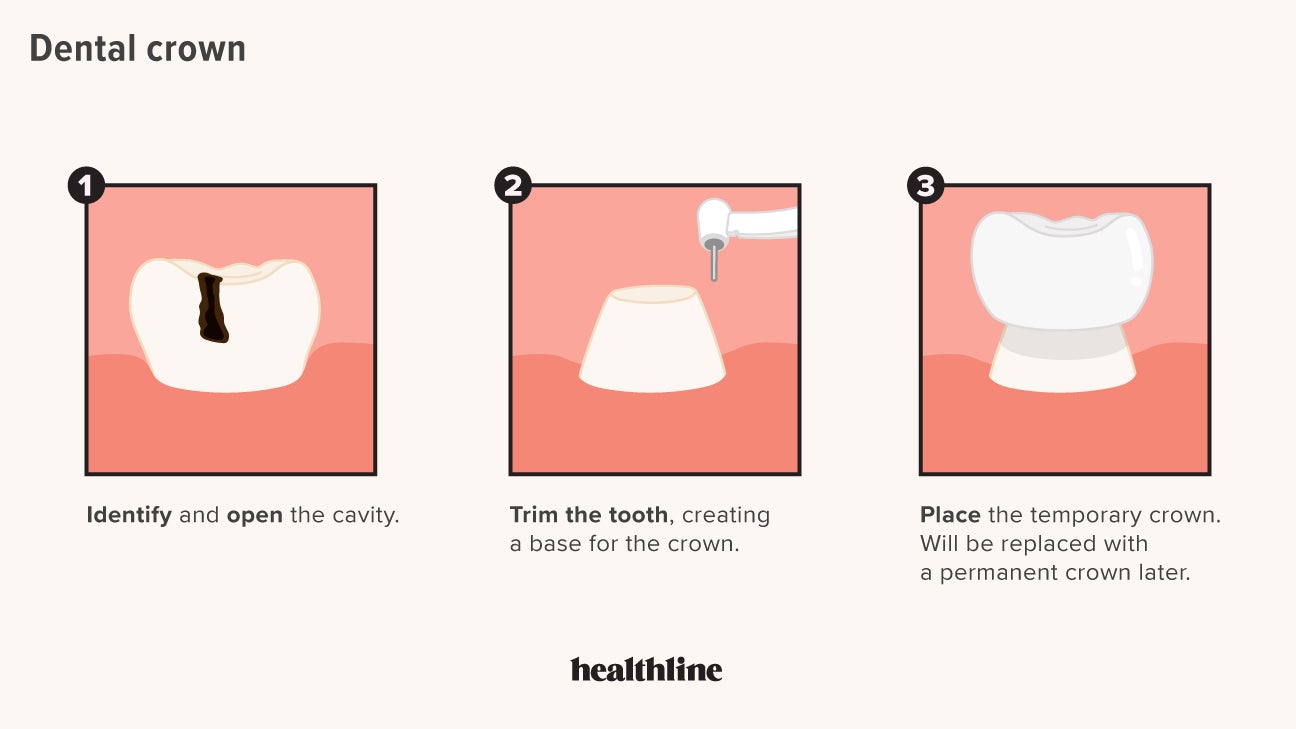 5 Types Of Dental Prosthesis Devices (2022)