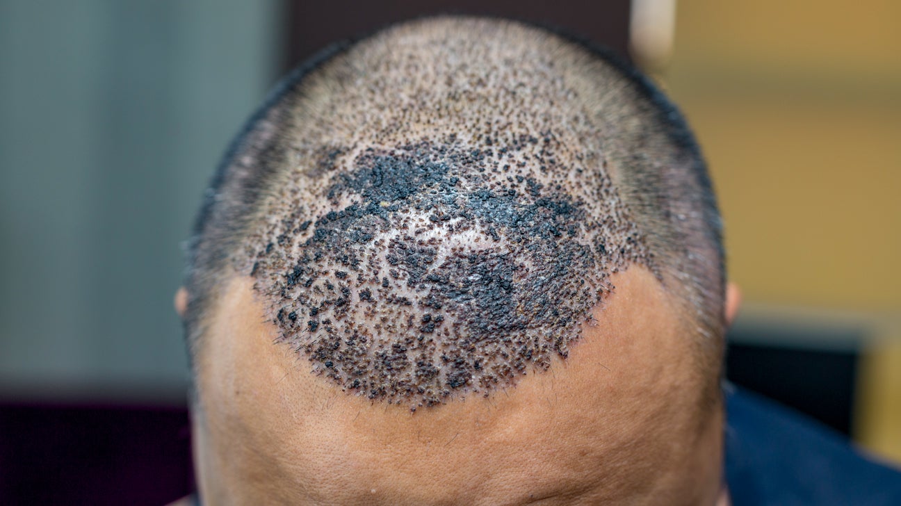 Infected Hair Transplant Symptoms Causes and Treatment