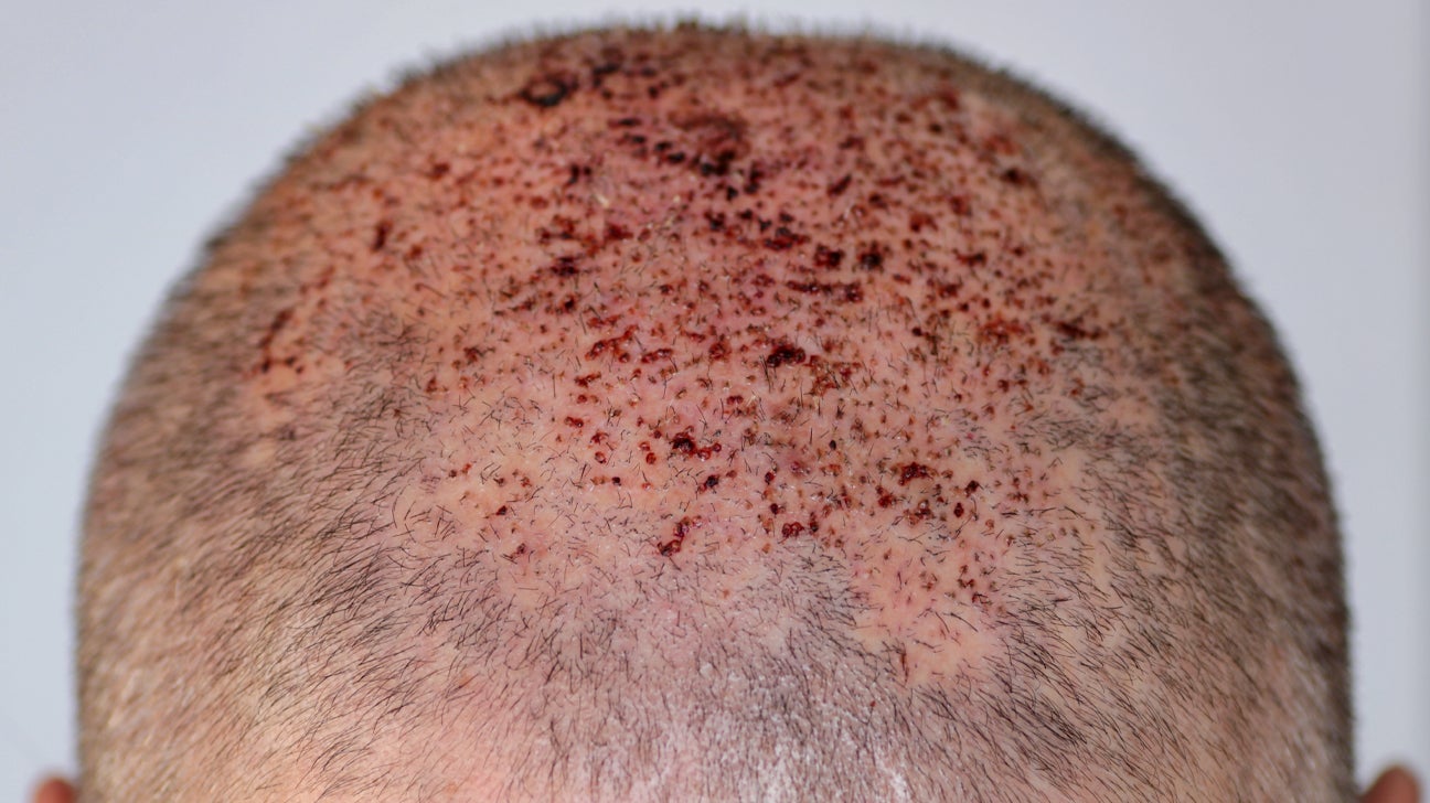 What Happens When Hair Transplants Go Wrong