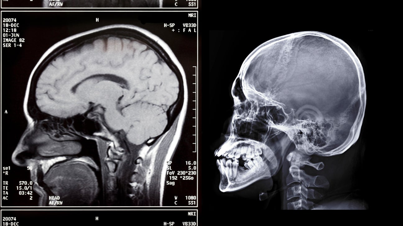 X Ray Of Brain