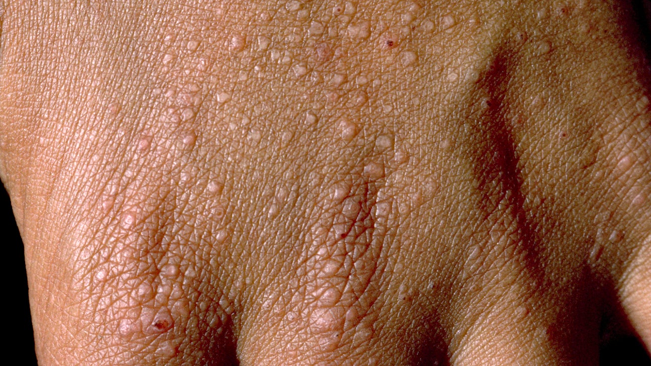 Papular Eczema Symptoms, Diagnosis, Treatment, and More