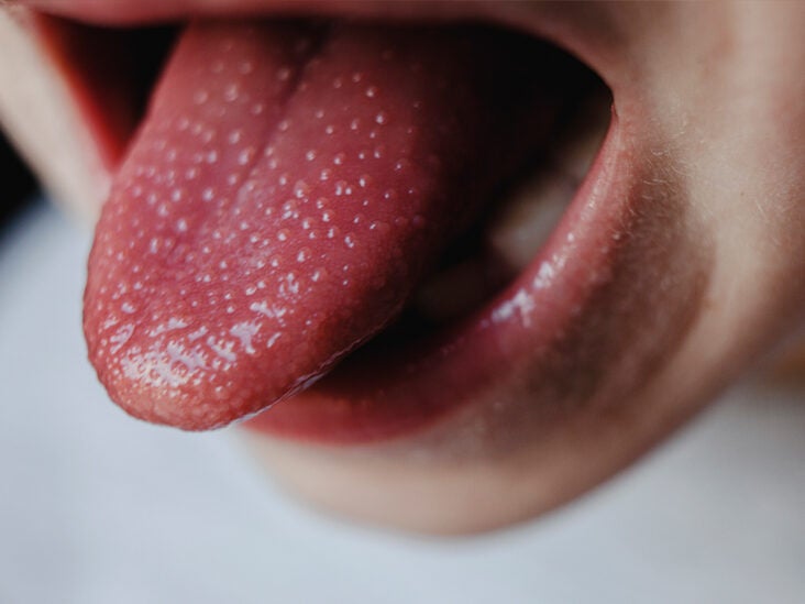 Mans tongue mysteriously turns black and hairy after stroke