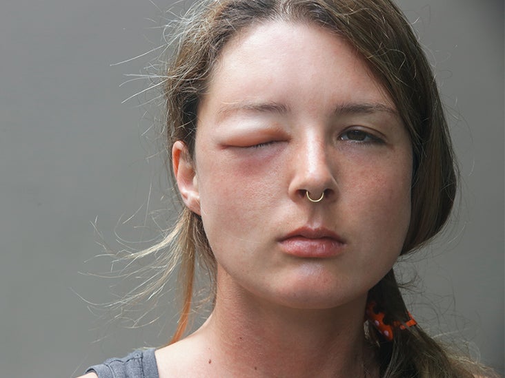 Mud Dauber Sting Symptoms, Risks, and Treatment